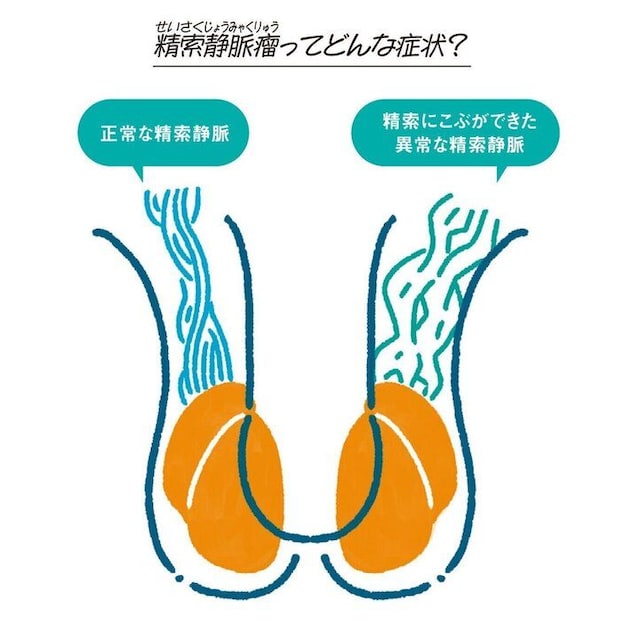 精索静脈瘤（せいさくじょうみゃくりゅう）ってどんな症状？