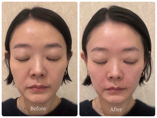 ほうれい線、一体どこいった!? 韓国在住40代ライターが感動【「フィラーの神様」施術レポート】