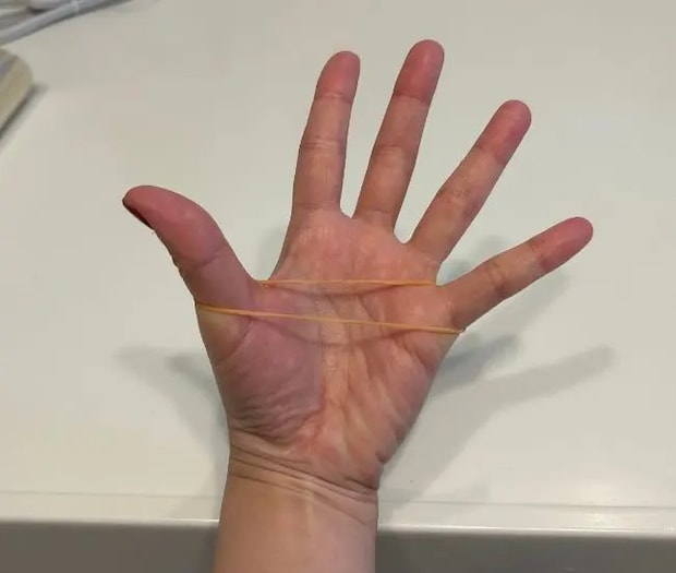 手に輪ゴムをかけた様子