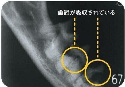歯の吸収病巣タイプ1