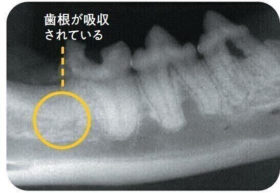 歯の吸収病巣タイプ3