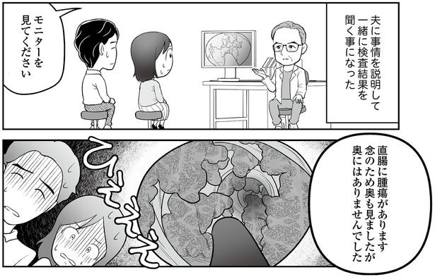 直腸に腫瘍があります