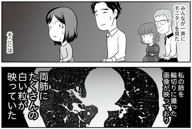 両肺にたくさんの白い粒が映っていた
