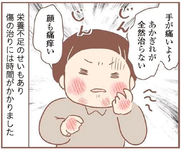 エスカレートしていく養母のいじめ。ひびやあかぎれだらけで血塗れに
