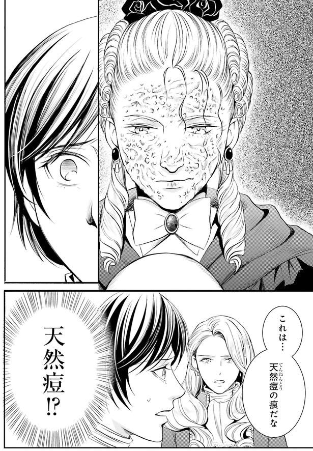 天然痘！？