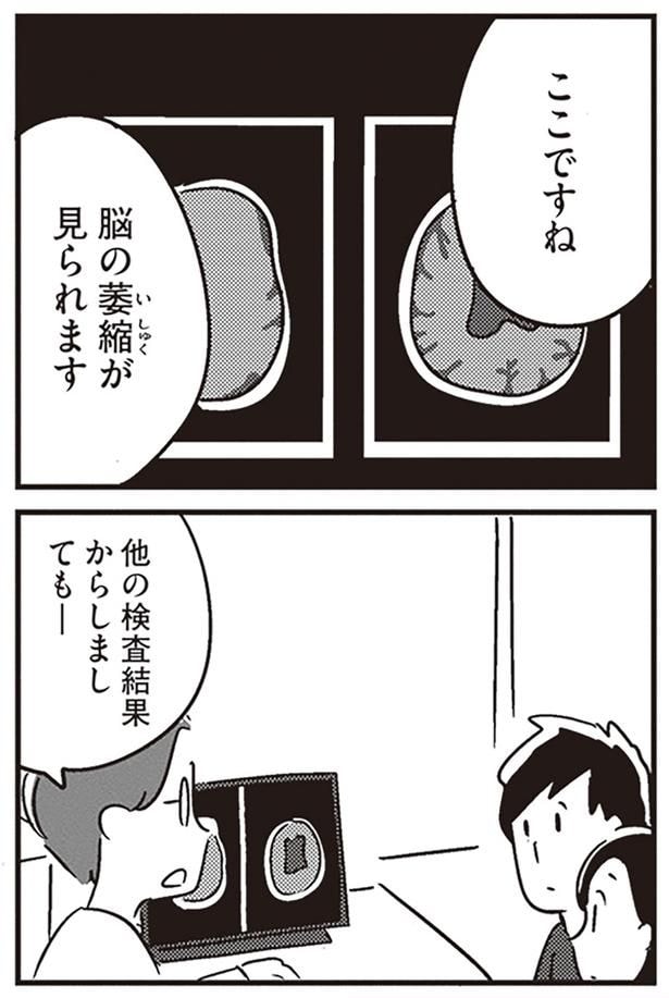 脳の萎縮が見られます