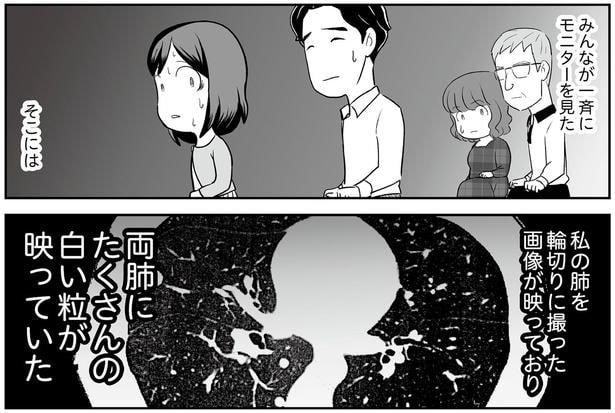両肺にたくさんの白い粒が映っていた