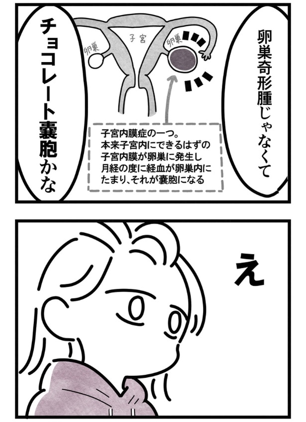 36歳でチョコレート嚢胞と診断されて驚く女性 33