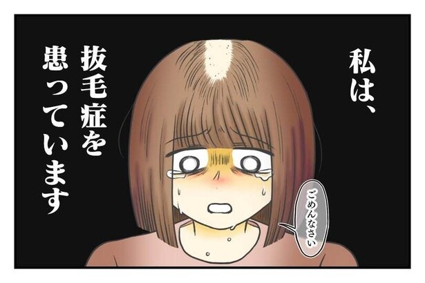 10代で抜毛症を患った女性