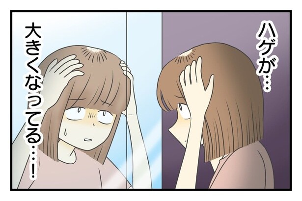ハゲがどんどん大きくなっていく 8-3