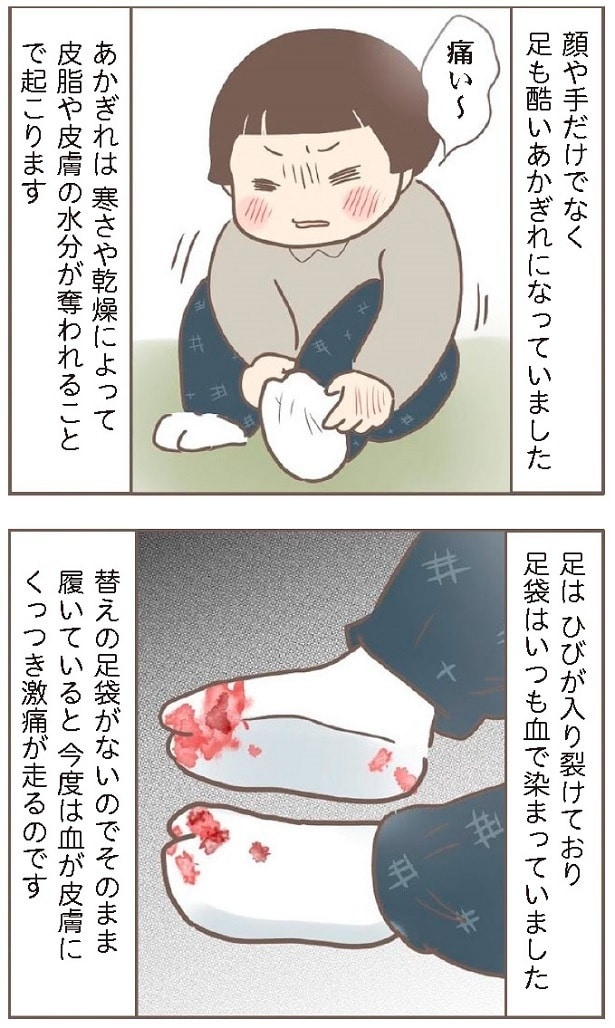 当時は冬の寒さや乾燥で手や顔だけでなく、足もあかぎれで苦しんだそう