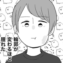 【親知らずの抜歯】輪郭が変わるほど腫れ上がった！「ミシミシという音が頭蓋骨に響く」過酷な痛み…わかる？【作者に聞く】