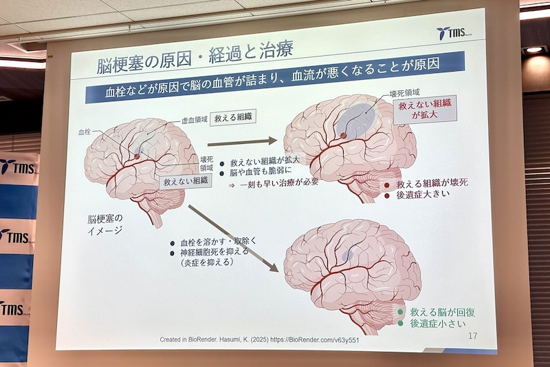 若者にも増える脳梗塞！　医師に聞いた「明日からできる予防法」と新薬の可能性