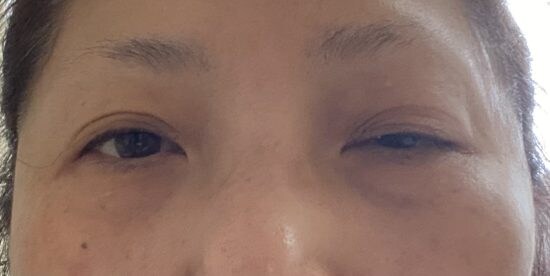 ［美容整形後遺症］の悪夢