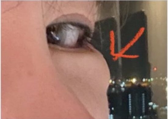 ［美容整形後遺症］の悪夢