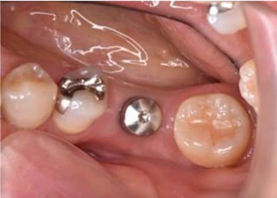 インプラント治療