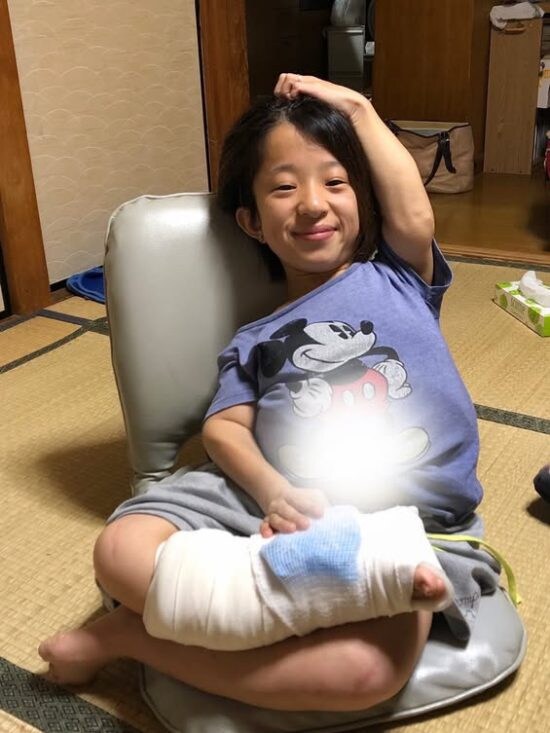 骨折した時の写真