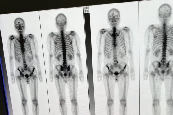 骨シンチグラフィ