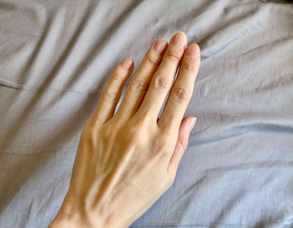  現在の筆者の手。治療のおかげで関節に変化なし（ゴツゴツしてるのは元からです）