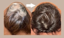 このままじゃ髪がヤバい！薄毛やパサパサ髪はよみがえるのか？人気沸騰の「育毛鍼灸師」に聞きました