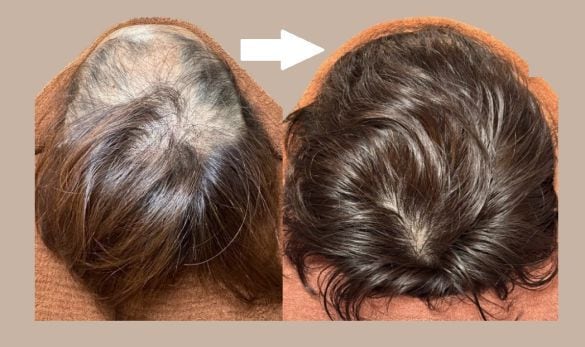 このままじゃ髪がヤバい！薄毛やパサパサ髪はよみがえるのか？人気沸騰の「育毛鍼灸師」に聞きました