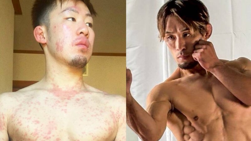 「病気が治れば幸せになれると思っていた」余命3カ月宣告から復帰した格闘家が直面した“見えない苦しみ”と社会とのズレ