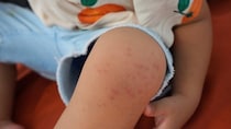 〈手足口病が急増〉「手・足・口だけとは限りません」全身に発疹、治った後に爪が剥がれることも…小児科医が教える受診の目安