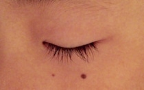 【閲覧注意】あなたの体にもできている！？　「赤いほくろのようなもの」の正体とは