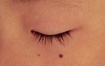 【閲覧注意】あなたの体にもできている？　「赤いほくろのようなもの」の正体とは