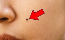 【写真】えっ……これが「命に関わる」かもしれない「悪いほくろの特徴」です（画像8枚）
