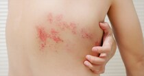 【ウソ…】「帯状疱疹」になりやすい部位があるの？　コレが入院が必要になる危険なサインです！