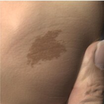 【画像で見る】「えっ…知らなかった」　これが保険適用で「レーザー治療」できる5種類の“あざ”です！