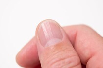 【えっ】「爪」表面に縦線、横線…ひょっとして病気のサイン？　気になる疑問を医師に聞く