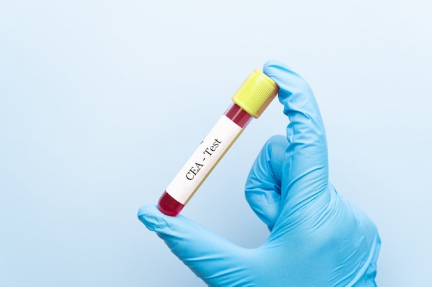 「腫瘍マーカー」が正常なら安心？　実は早期がん発見には不向き…内視鏡専門医が教える“本当に受けるべき検査”とは