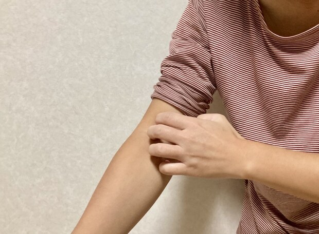 「トコジラミ」春から活発化　“従来の駆除剤”が効かない場合も　対策をアース製薬に聞く