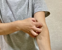 “蚊”に刺された！　かゆくてガリガリ引っかく→感染症＆難病発症のリスクがUP？　皮膚科医が解説