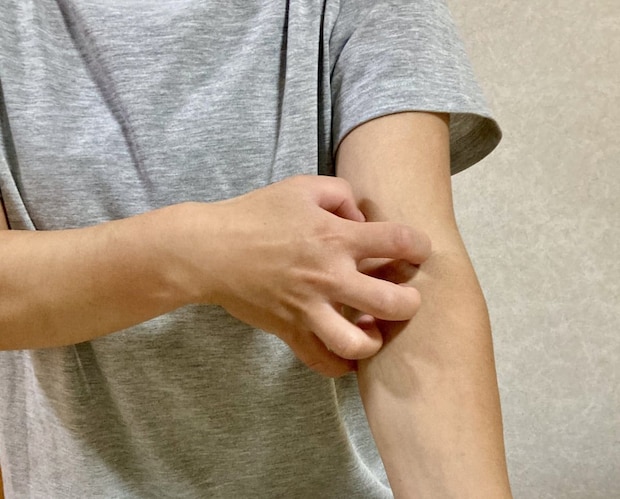 “蚊”に刺された! かゆくてガリガリ引っかく→感染症&難病発症のリスクがUP? 皮膚科医が解説