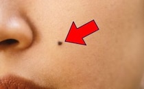 美容皮膚科医が警鐘！　実は恐ろしい「悪いほくろ」は“早期発見”が何よりも重要…見分け方は？