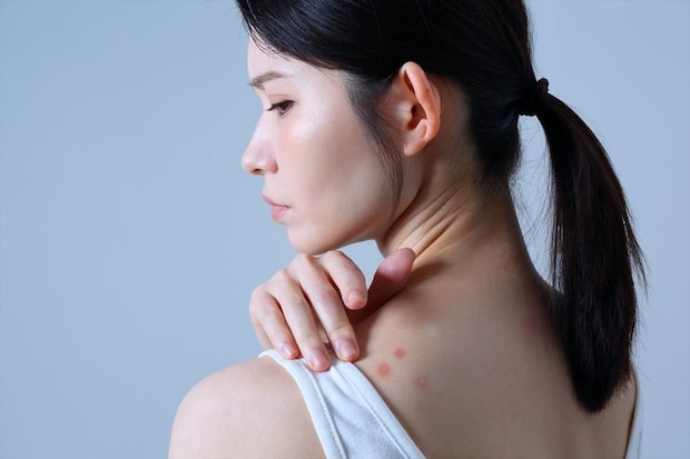 赤い“ポチ”…ニキビだと思ったら「粉瘤」! 根本治療は「手術」 汗ばむ季節は悪化“リスク増”