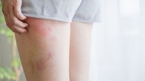 手ごわい「ダニ」め…　洗濯＆掃除機だけはNG？　死滅させる駆除法とは