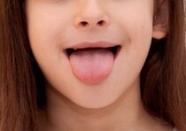 食事でクチャクチャ音？　舌の位置が低い「低位舌」の原因・弊害・治療法