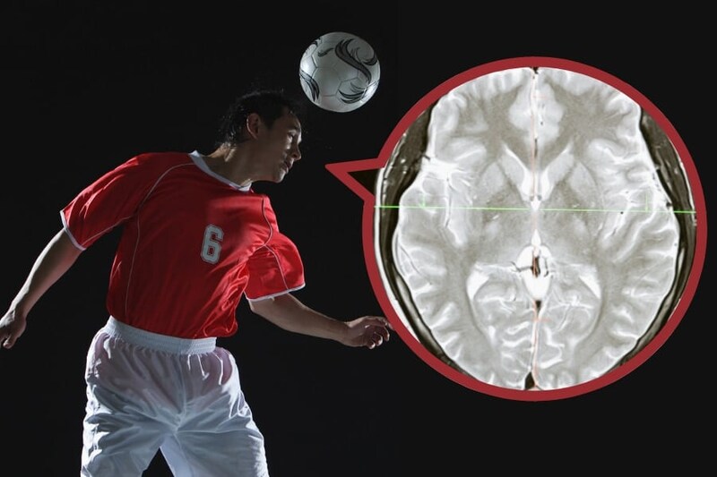 ヘディング多用者は「脳の灰白質と白質の境界が”にじんでいる”」と判明