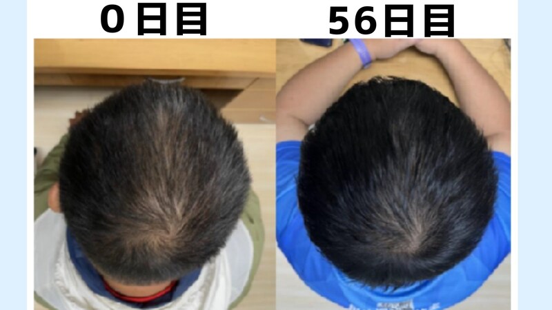 8週間で髪が「太く・多く・長く」――植物EVが育毛を導く