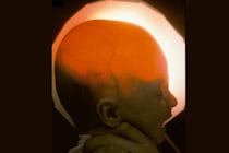 脳の大部分が欠損して生まれた女性が20歳に、医学的予想を覆す