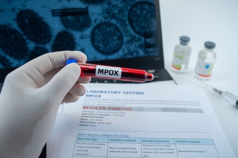 新たに進化した「エムポックス変異株」を確認、英国保健当局が報告