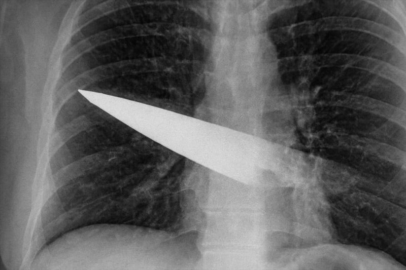 胸に刺さったナイフに気づかず「8年間」過ごした男性