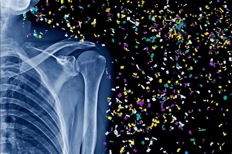 人間の骨の奥深くにマイクロプラスチックを発見