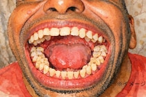 世界一「歯が多い」男性、30代でそのことに気づく【ギネス記録・映像あり】