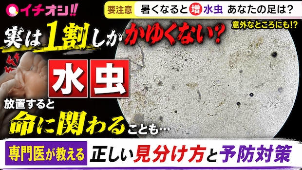 【かゆくない水虫が9割?】専門医に聞く、足以外にも広がる意外な症状と今日からできる予防法