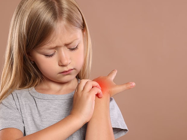 子どもはしもやけになりやすいって本当？対処法について小児外科専門医竹内先生にお伺いしました